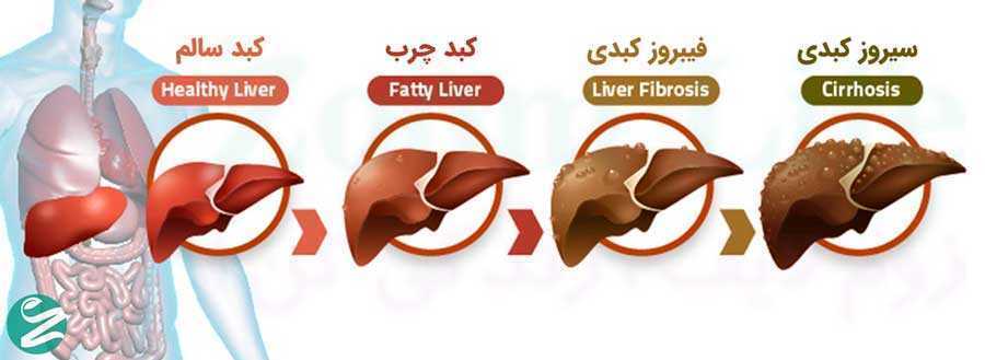 کبد چرب چند گرید دارد و علائم هر کدام چیست؟ چگونه پیشگیری و درمان کنیم؟