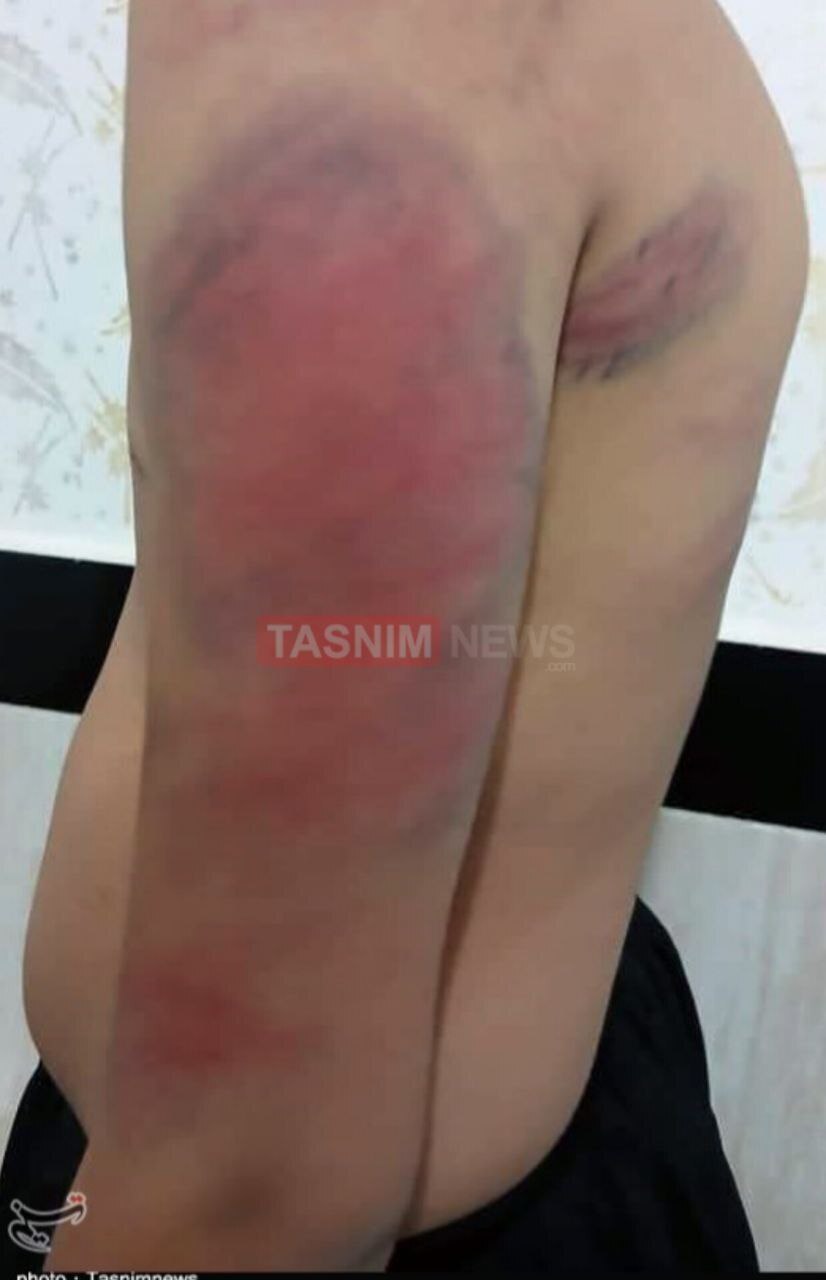 ضرب‌وشتم وحشتناک دانش‌آموزان توسط معلم در سنندج/ یک دانش‌آموز در بیمارستان بستری شد/ آموزش وپرورش: معلم خاطی مشکل روانی دارد/ حکم اخراجش از شهرستان صادر می‌شود + تصاویر