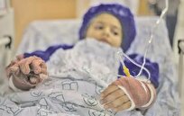 رییس بیمارستان گناوه: سوختگی با آب جوش شایع‌ترین علت سوختگی در اطفال