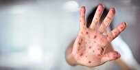 سرخک ۲۹ نفر را در بابل روانه بیمارستان کرد