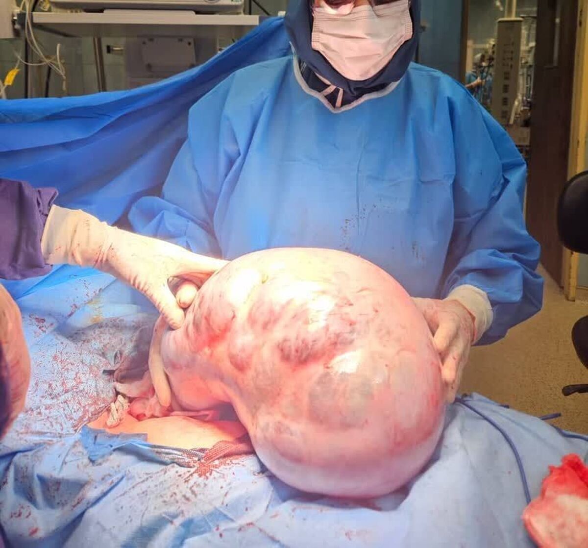 خارج کردن توده ۱۰ کیلویی از شکم یک بیمار در کرج + عکس خارج کردن توده ۱۰ کیلویی از شکم یک بیمار در کرج + عکس