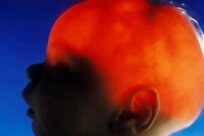 مورد عجیب الکس سیمپسون؛ نوزادی که تقریباً بدون مغز متولد شد، ۲۰ سالگی‌اش را جشن گرفت